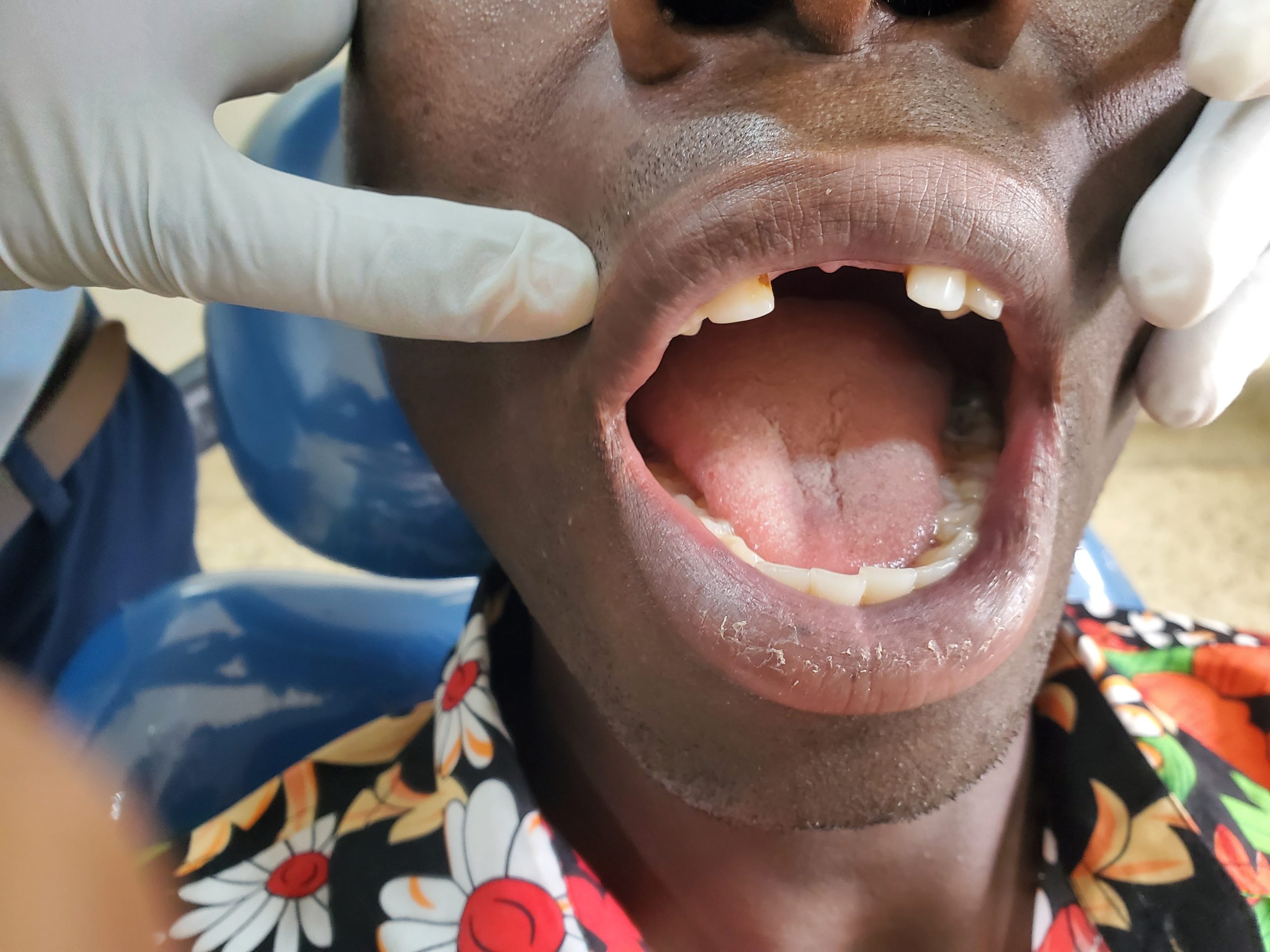 Dentures Result 2