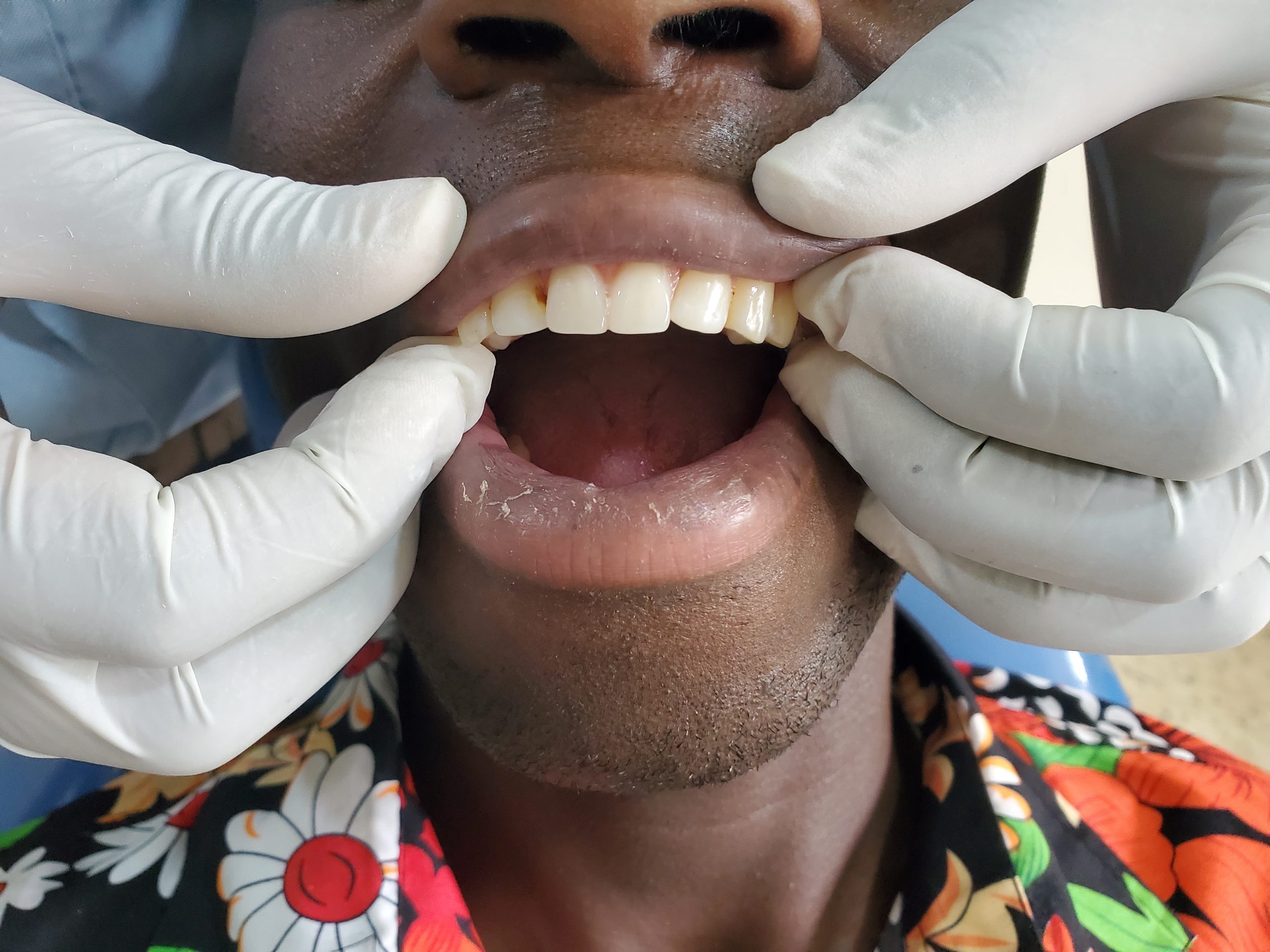 Dentures Result 1